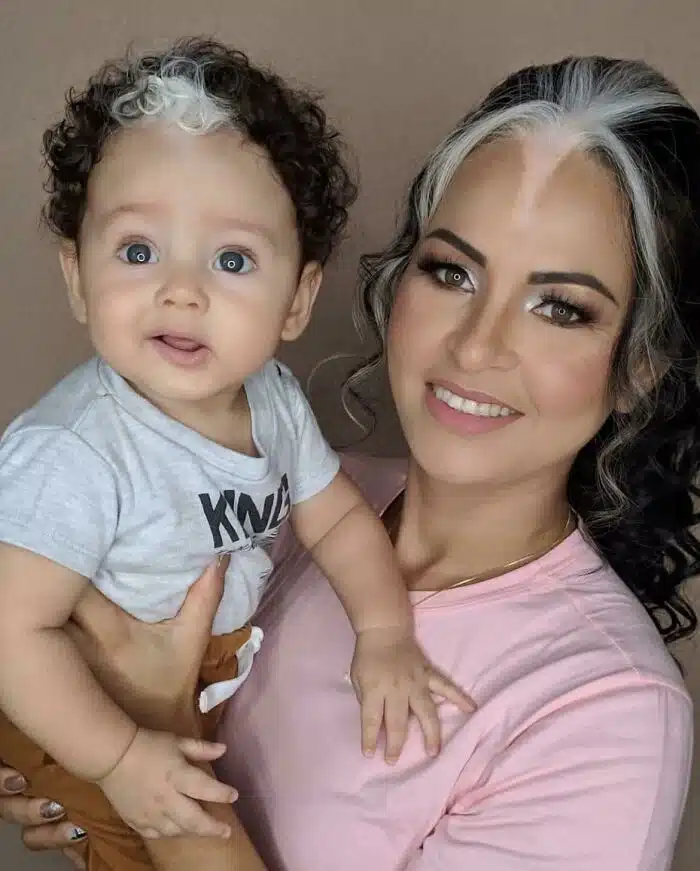 A woman and child with poliosis.