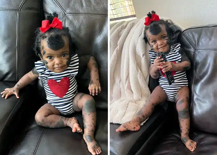 Congenital Melanocytic Nevus