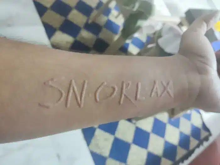 Dermatographia