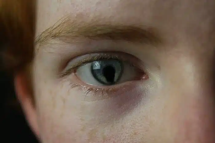 Rare Eye Condition
