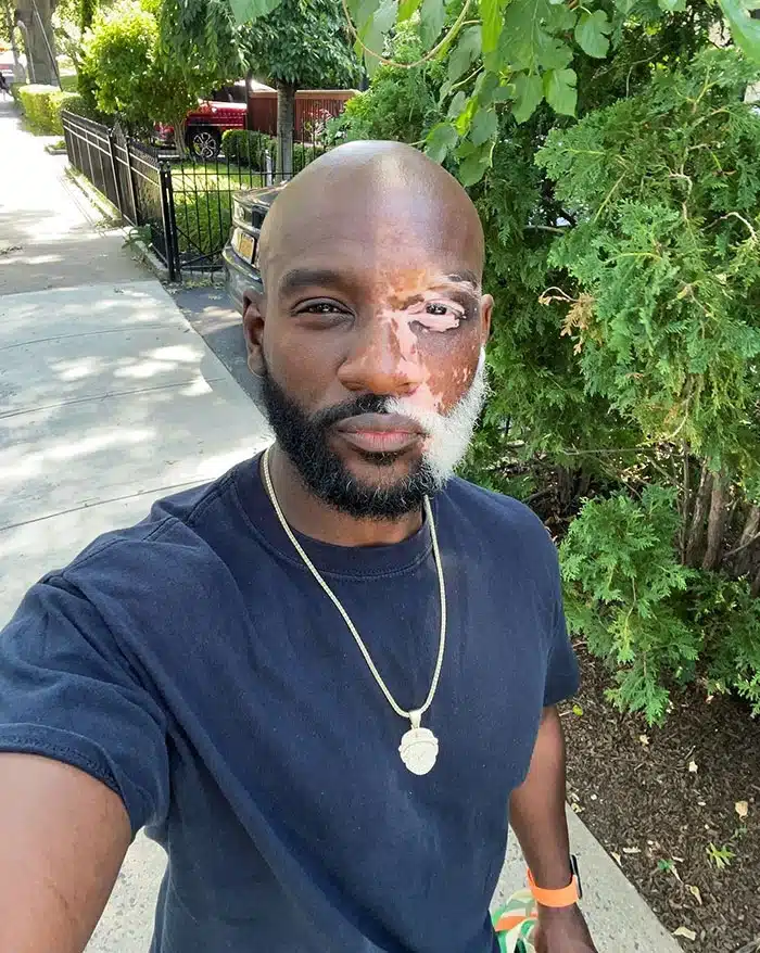 Vitiligo